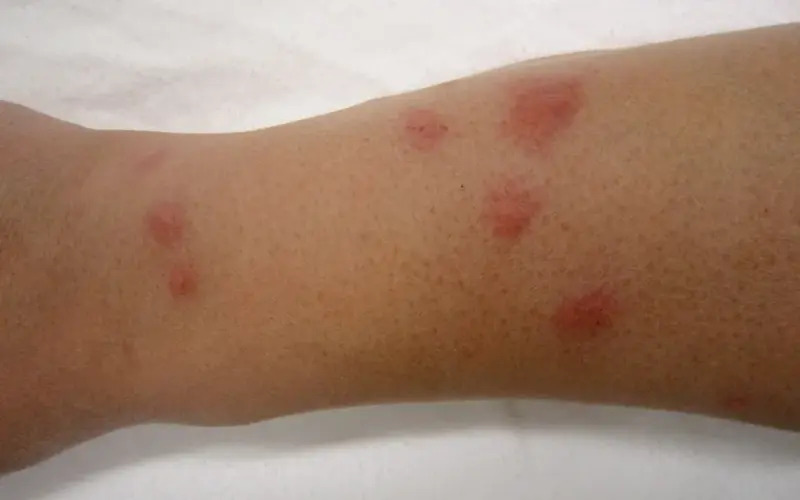 How Does a Bed Bug Attack